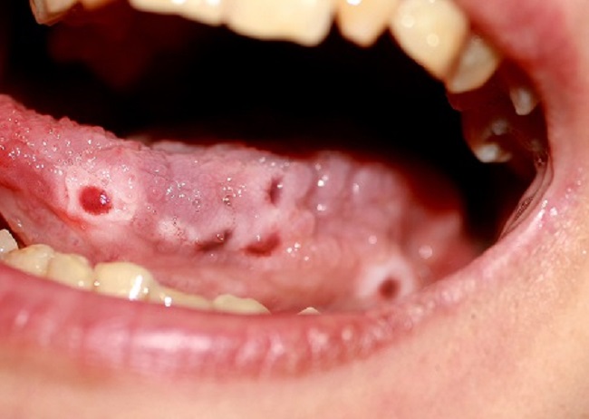 Candidiasis-of-the-Tongue