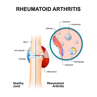 Rheumatoid-Arthritis