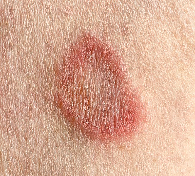 Skin Yeast Infection Pictures