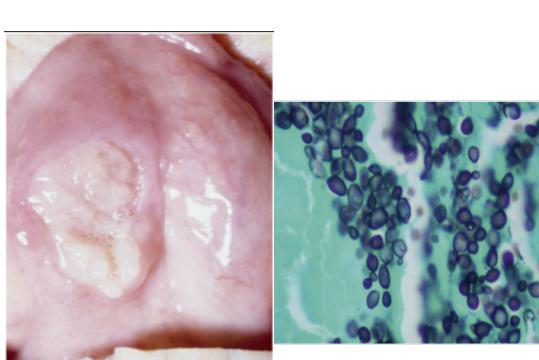 Saccharomyces-cerevisiae-laryngitis