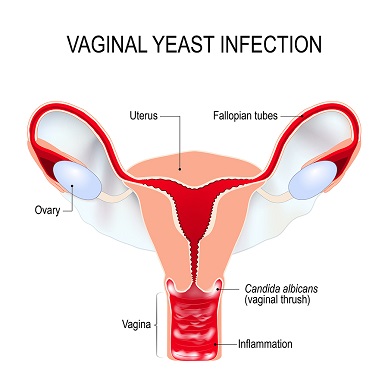 Vaginal-Yeast-Infection