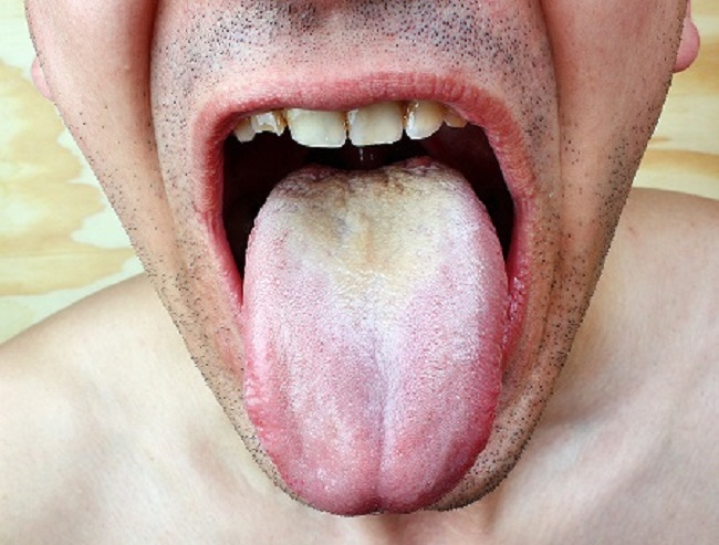 Oral Yeast Infection Pictures