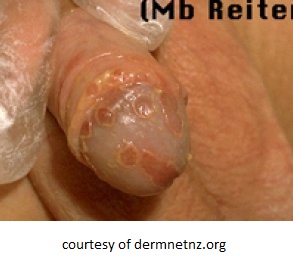 Balanitus-Penis-Yeast-Infection