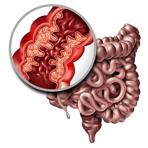 Crohns-Disease