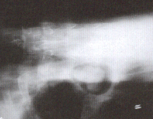 aspergillis fungi in lung