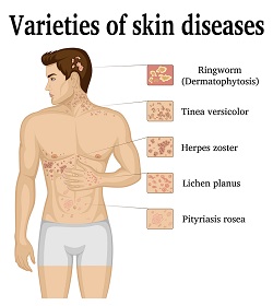 skin-disease-charts