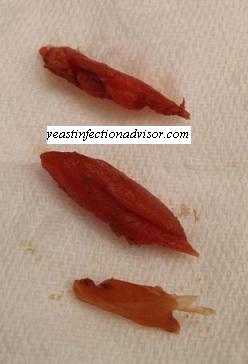 Fasciola-hepatica-liver-flukes