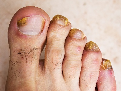 Fungal-Infection-on-Toenails