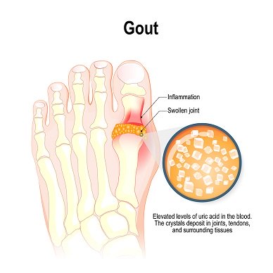 Gout-Inflammation