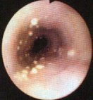 yeast in esophagus