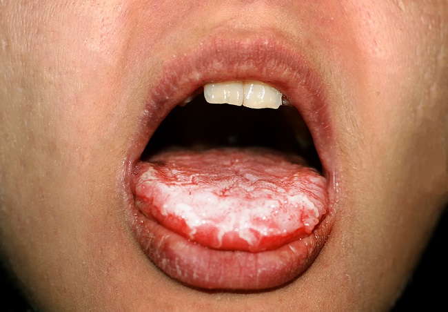 oral-yeast-infection-on-tongue