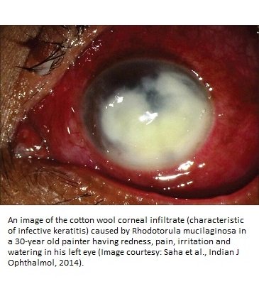 Rhodotorula-mucilaginosa-infection-of-the-eye