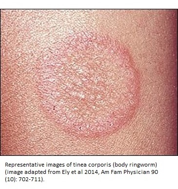 Tinea-Corporis-Ringworm