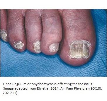 Tinea-unguium-toe-fungus