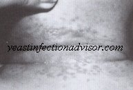 yeast infection on neck