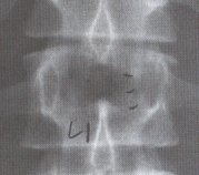 yeast fungi in vertebrae