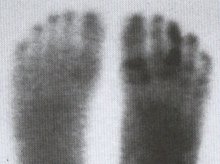 yeast fungi in feet
