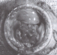 heart valve closed by yeast