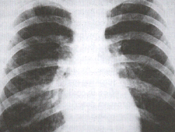 fungi in lungs