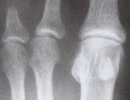 ostyomyelitis in fingers