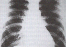 yeast fungi in lungs